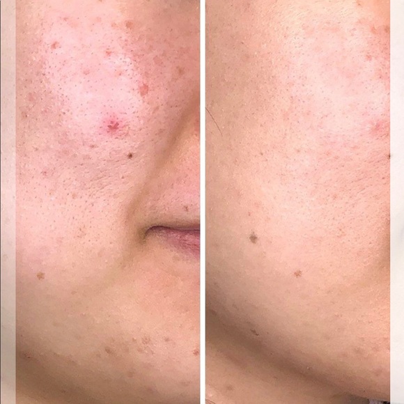 ACEOLOGY-DETOXIFYING TREATMENT MASK - Picture 4 of 6